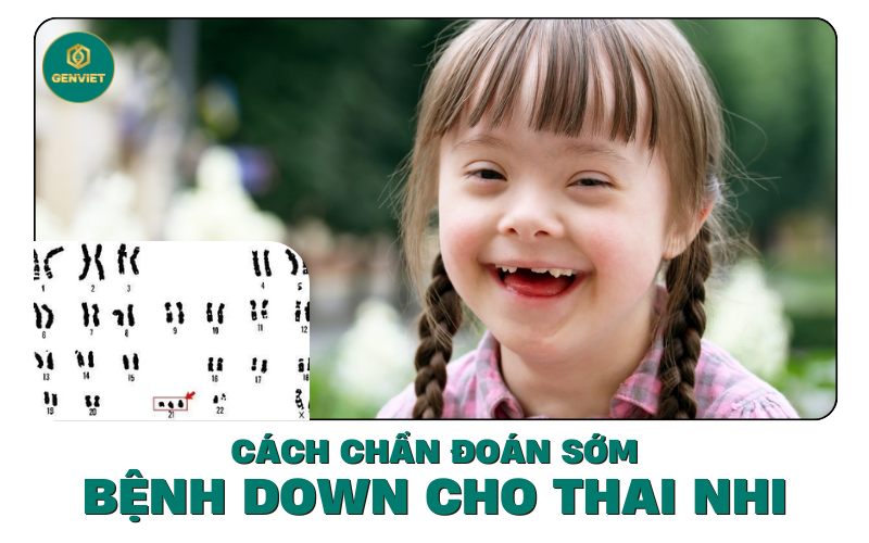 cach-chuan-doan-benh-down