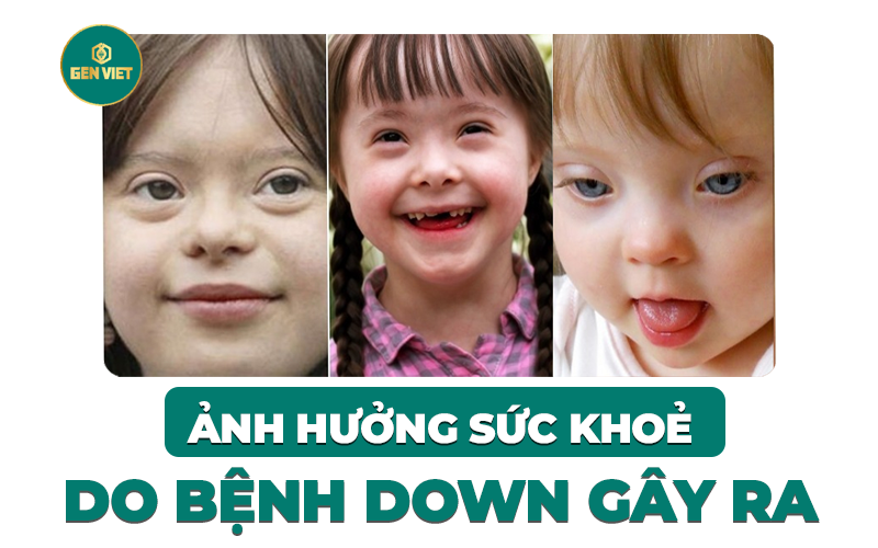 anh-huong-suc-khoe-benh-down-gay-ra