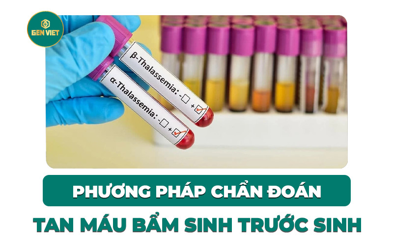 phuong-phap-chuan-doan-benh-tan-mau-bam-sinh