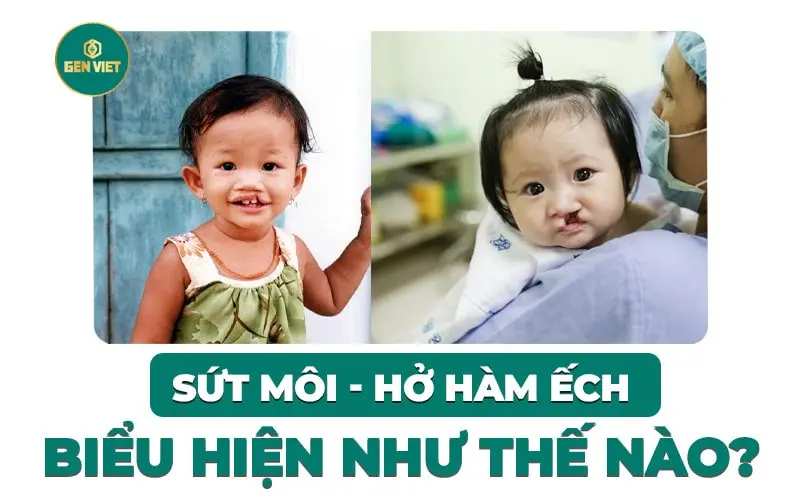 sut-moi-ho-ham-ech-bieu-hien-nhu-the-nao