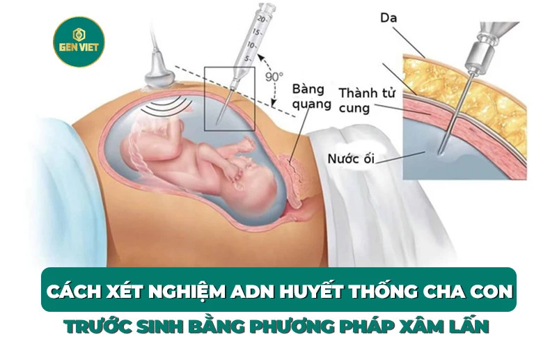 xet-nghiem-adn-cha-con-truoc-sinh-xam-lan